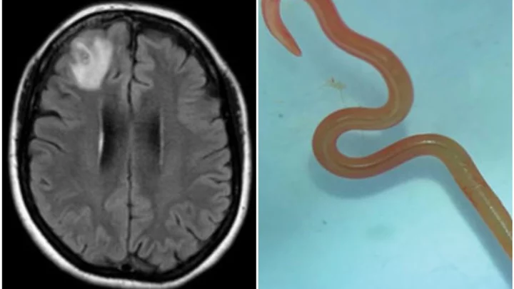 Live worm discovered in woman's brain in a worrying world first